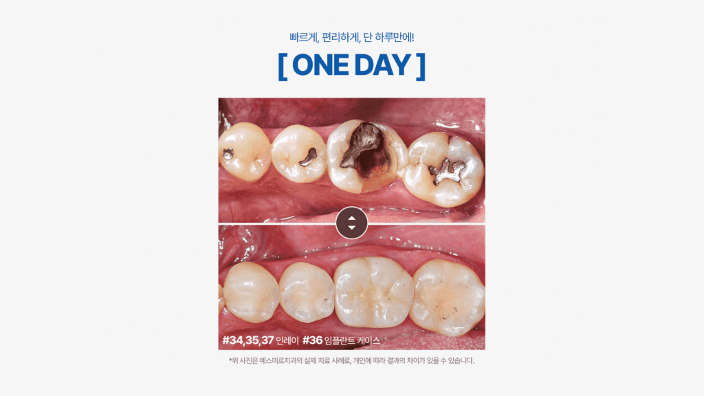 원데이 치료 라운딩